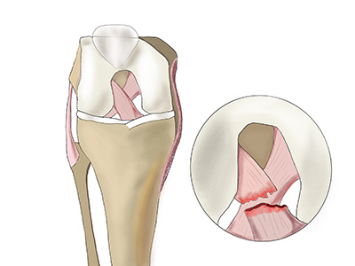 Anterior cruciate ligament rupture. Symptoms Treatment.